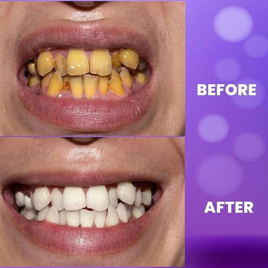 Purple Teeth Whitening Gel with Natural Ingredients